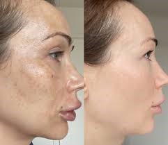 Dermapen Treatment in Navi Mumbai